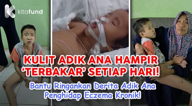 KULIT ANA 'TERBAKAR' SETIAP HARI, BANTU ANA DAPATKAN RAWATAN!